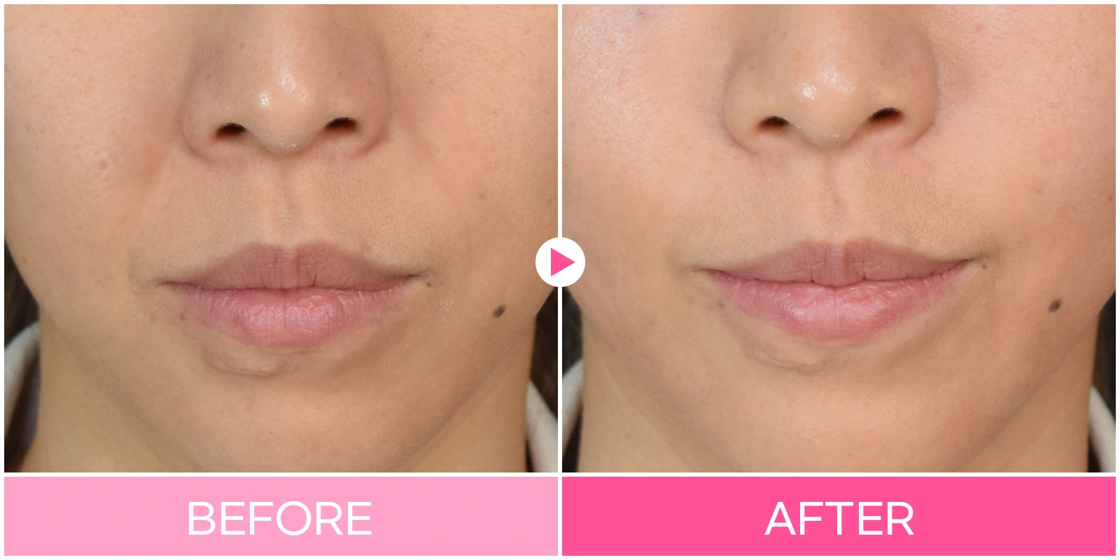 Nasolabial-fold filler: close-up around the mouth at EG DONG AN Clinic. EG DONG AN Clinic, Seoul — nasolabial-fold filler: close-up around the mouth. Before on the left; after on the right.