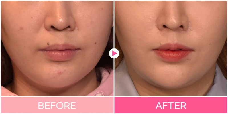 Nasolabial-fold filler: lower-face comparison at EG DONG AN Clinic. EG DONG AN Clinic, Seoul — nasolabial-fold filler: lower-face comparison. Before on the left; after on the right.
