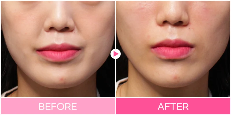 Nasolabial-fold filler: frontal mouth-area detail at EG DONG AN Clinic. EG DONG AN Clinic, Seoul — nasolabial-fold filler: frontal mouth-area detail. Before on the left; after on the right.