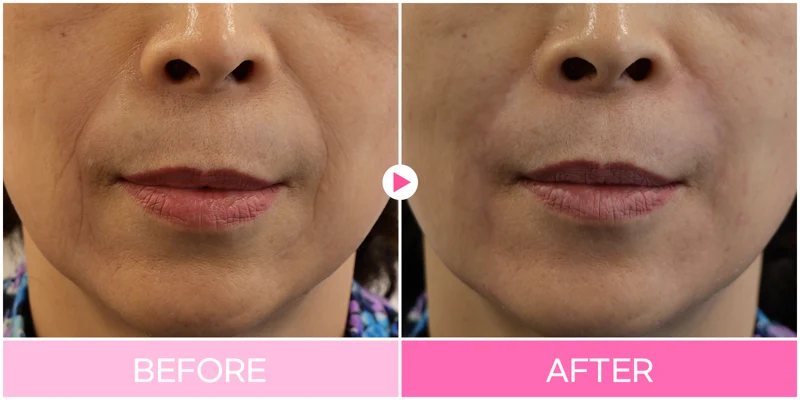Nasolabial-fold filler: cheek-to-mouth folds at EG DONG AN Clinic. EG DONG AN Clinic, Seoul — nasolabial-fold filler: cheek-to-mouth folds. Before on the left; after on the right.
