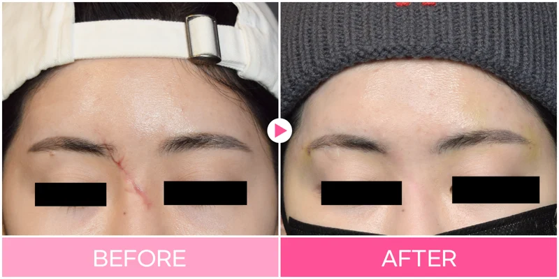 Scar treatment: nasal bridge and brow area at EG DONG AN Clinic. EG DONG AN Clinic, Seoul — scar treatment: nasal bridge and brow area. Before on the left; after on the right.