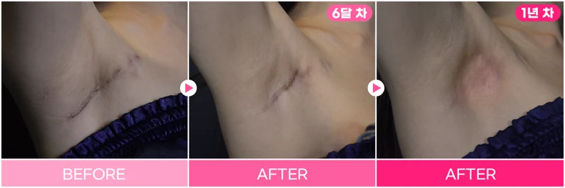 Scar treatment: six-month and one-year views at EG DONG AN Clinic. EG DONG AN Clinic, Seoul — scar treatment: six-month and one-year views. Before, six months and one year, left to right.
