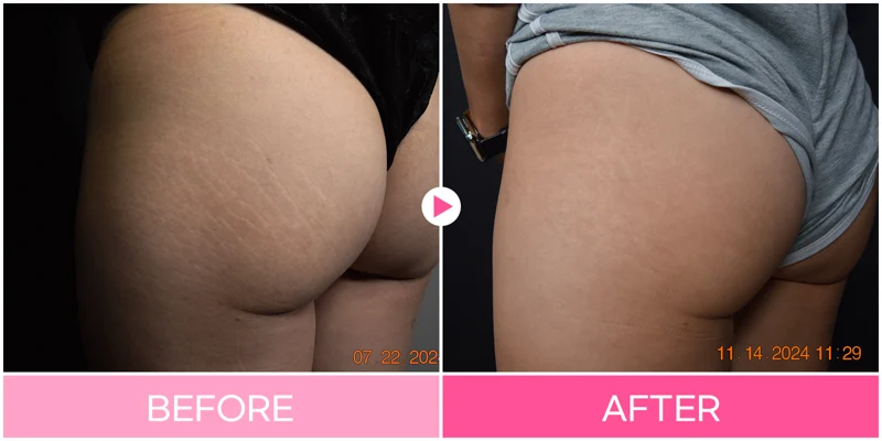 Body scar treatment: side-view skin texture at EG DONG AN Clinic. EG DONG AN Clinic, Seoul — body scar treatment: side-view skin texture. Before on the left; after on the right.