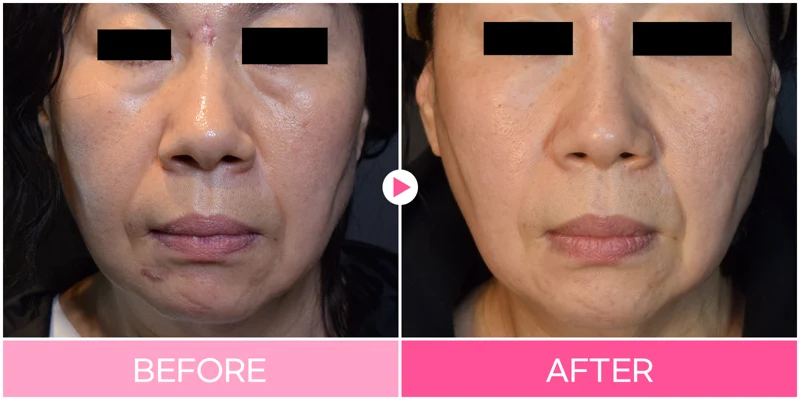 Facial scar treatment: central-face comparison at EG DONG AN Clinic. EG DONG AN Clinic, Seoul — facial scar treatment: central-face comparison. Before on the left; after on the right.