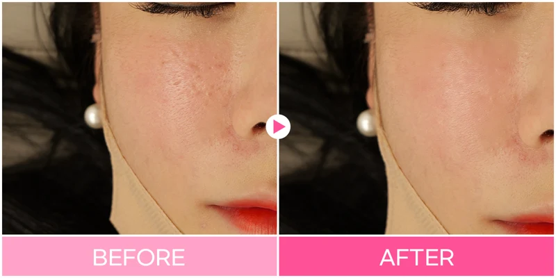 Cheek scar treatment: close-up texture at EG DONG AN Clinic. EG DONG AN Clinic, Seoul — cheek scar treatment: close-up texture. Before on the left; after on the right.