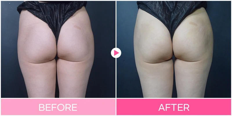 Hip-dip contouring: rear-view comparison at EG DONG AN Clinic. EG DONG AN Clinic, Seoul — hip-dip contouring: rear-view comparison. Before on the left; after on the right.