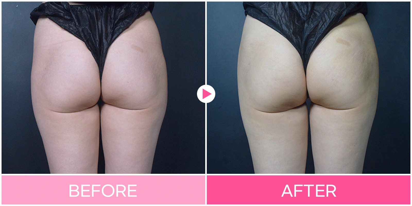 Hip-dip contouring: rear-view comparison at EG DONG AN Clinic. EG DONG AN Clinic, Seoul — hip-dip contouring: rear-view comparison. Before on the left; after on the right.