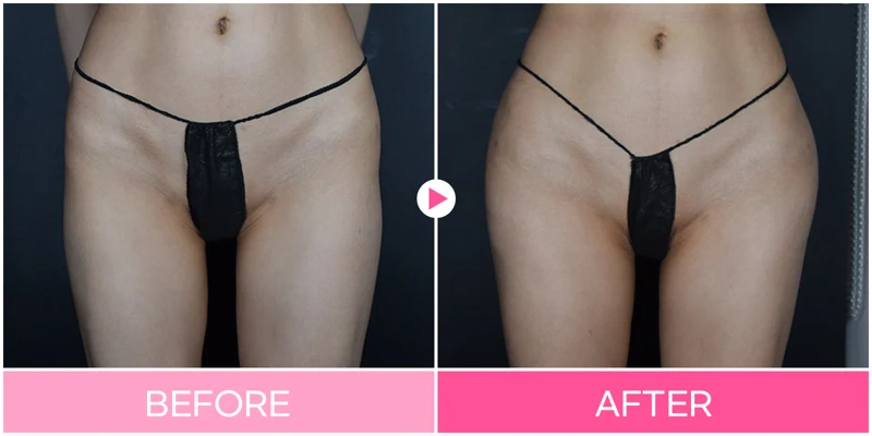 Hip-dip contouring: front-view comparison at EG DONG AN Clinic. EG DONG AN Clinic, Seoul — hip-dip contouring: front-view comparison. Before on the left; after on the right.