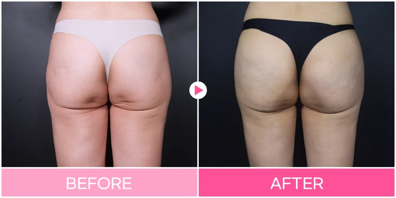 Hip-dip contouring: hip and buttock outline at EG DONG AN Clinic. EG DONG AN Clinic, Seoul — hip-dip contouring: hip and buttock outline. Before on the left; after on the right.