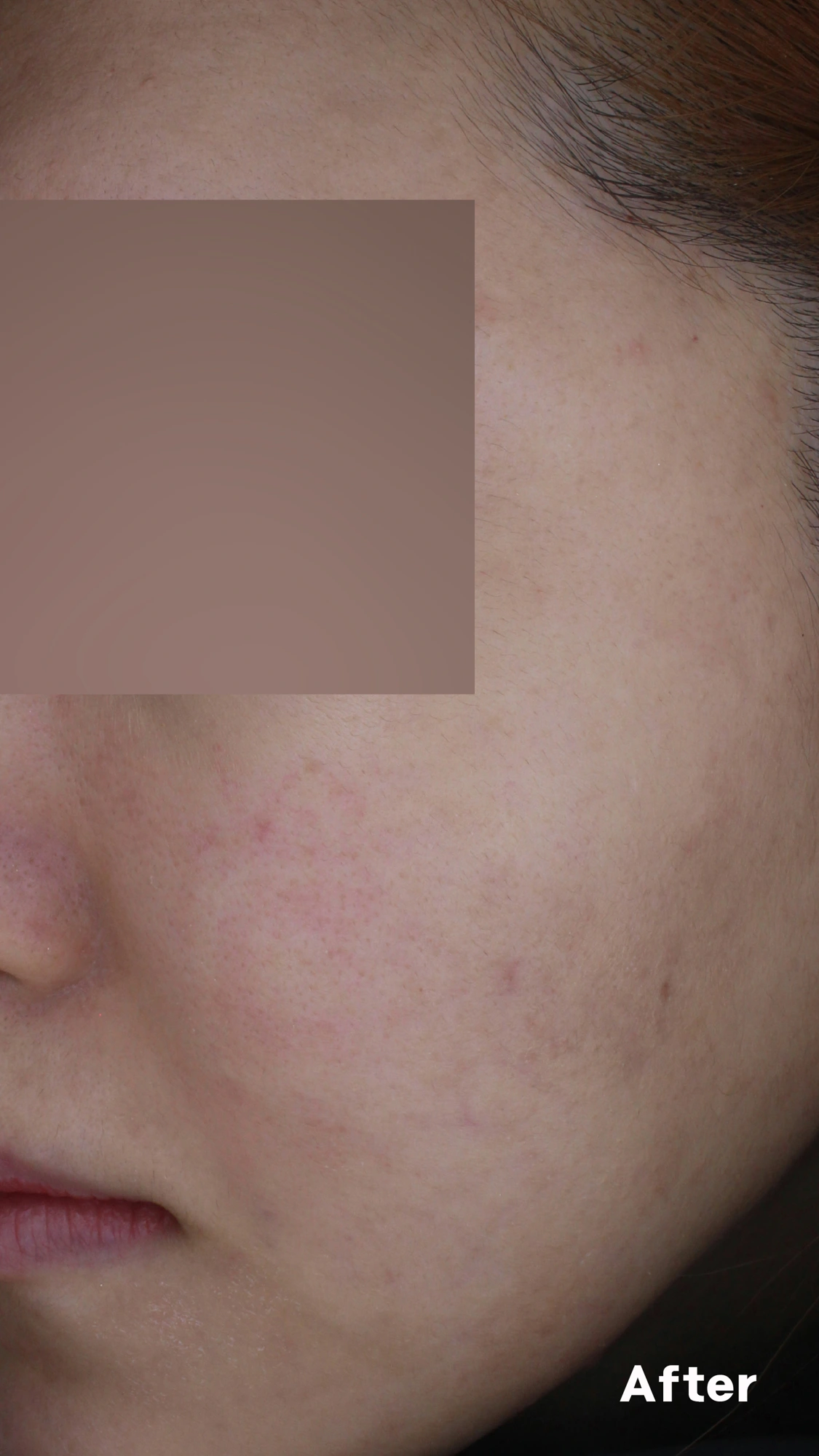 Acne across the cheek and forehead at Eun Skin Clinic — after treatment