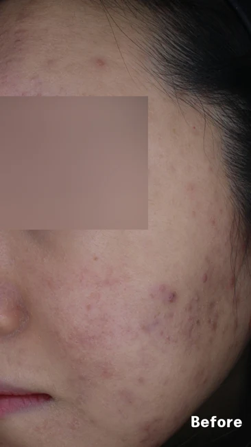 Acne across the cheek and forehead before and after at Eun Skin Clinic