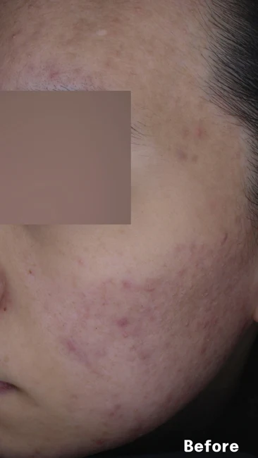 Acne and cheek redness before and after at Eun Skin Clinic