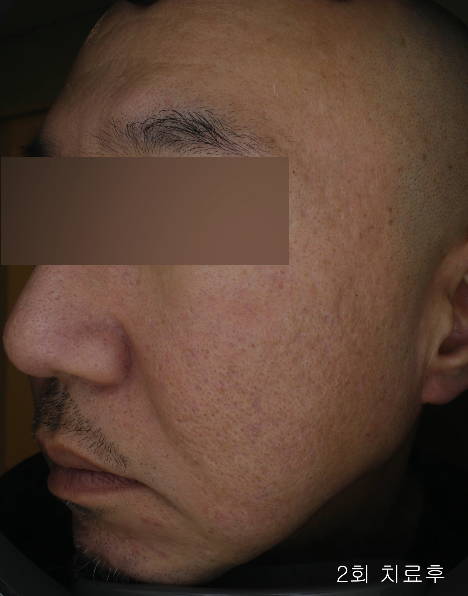 Acne scars after two treatments at Eun Skin Clinic — after two treatments