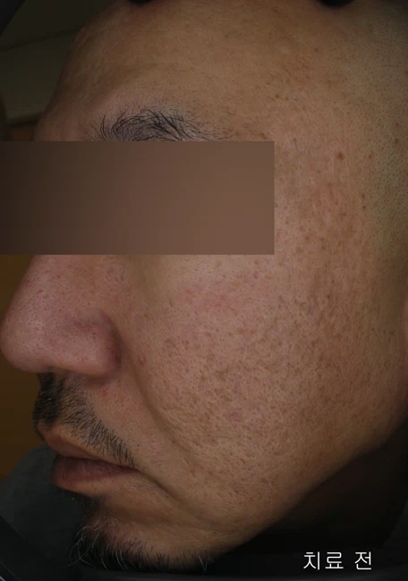 Acne scars after two treatments before and after at Eun Skin Clinic