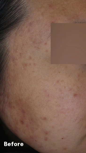 Acne from the temple to the lower cheek before and after at Eun Skin Clinic