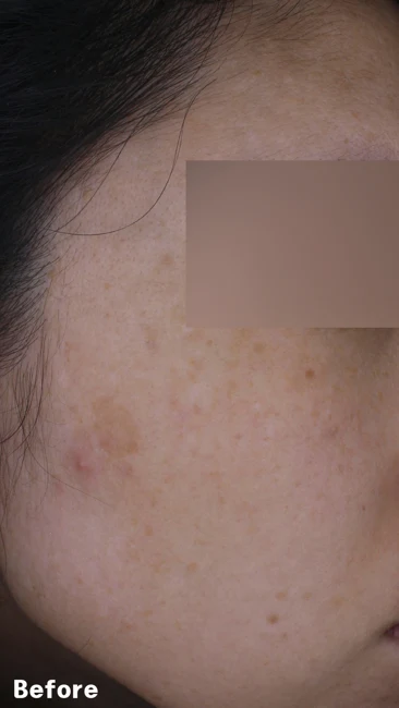 Facial pigmentation before and after at Eun Skin Clinic