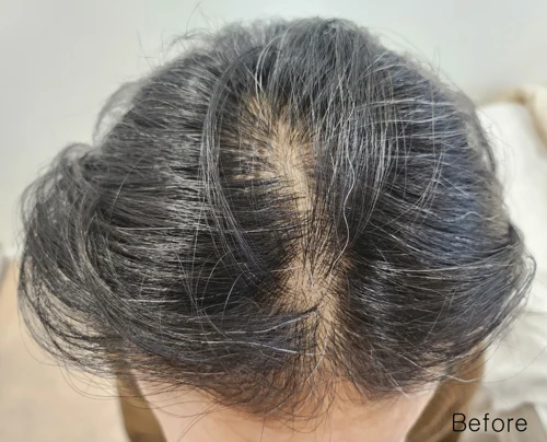Hair loss: three and five treatments before and after at Eun Skin Clinic