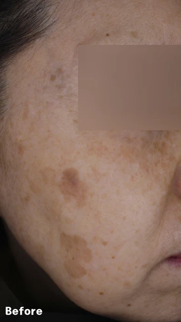Lentigines on the cheek before and after at Eun Skin Clinic