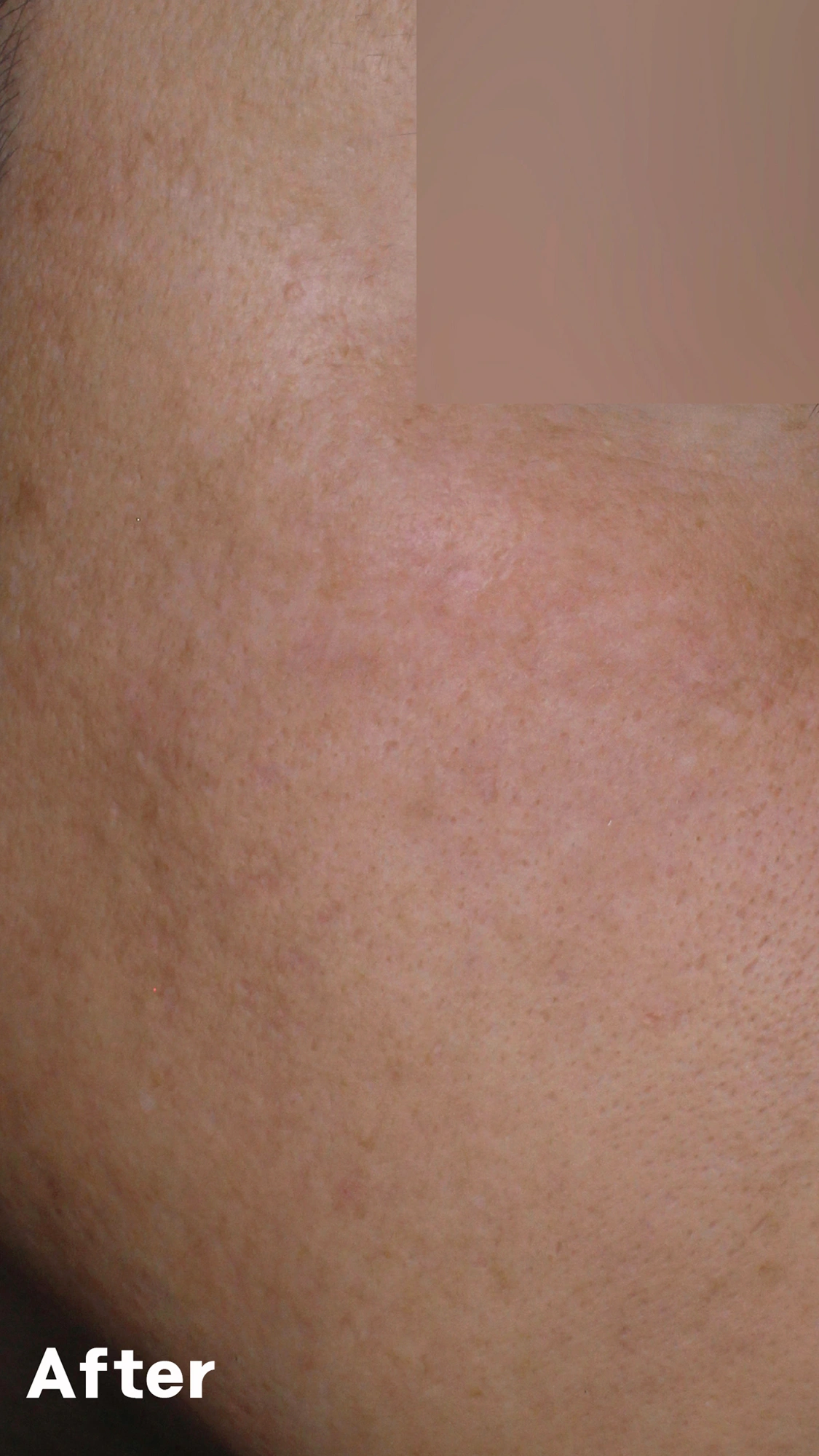 Melasma: a closer view of the cheek at Eun Skin Clinic — after treatment