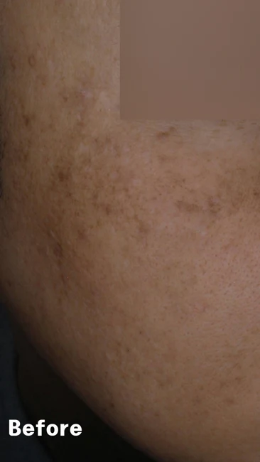 Melasma: a closer view of the cheek before and after at Eun Skin Clinic