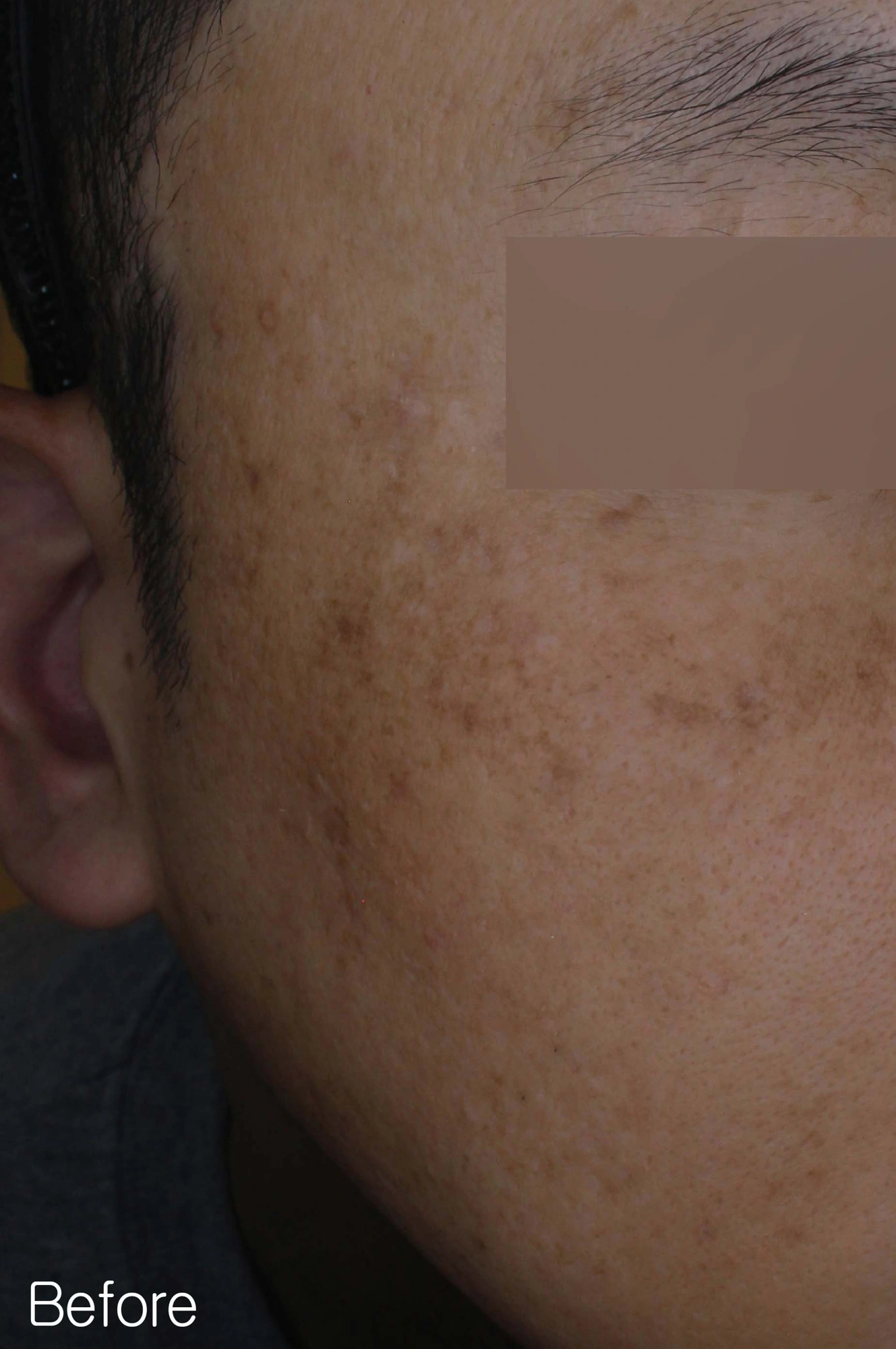 Melasma along the cheek at Eun Skin Clinic — before treatment