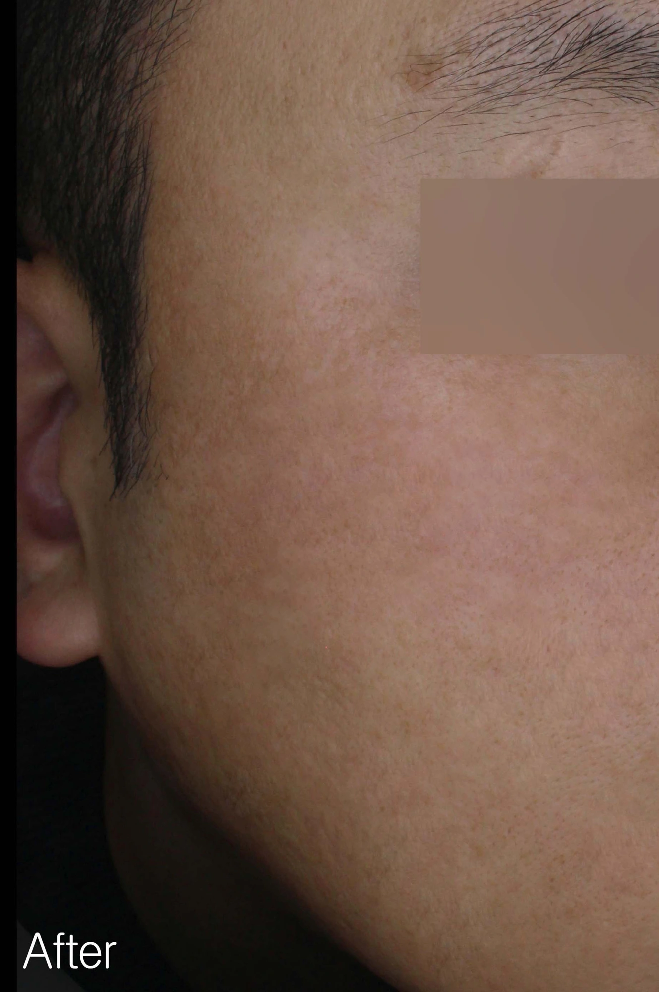 Melasma along the cheek at Eun Skin Clinic — after treatment