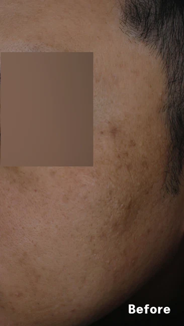Melasma around the temple before and after at Eun Skin Clinic