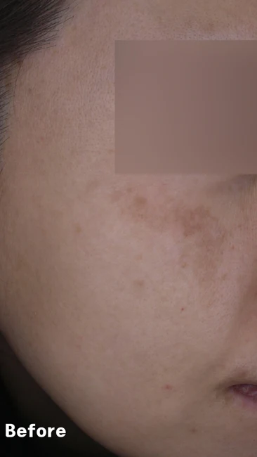 Melasma beneath the eye before and after at Eun Skin Clinic