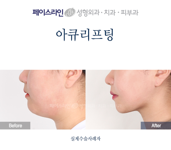 Accu lifting: lower-face profile comparison 01 before and after at Faceline Plastic Surgery
