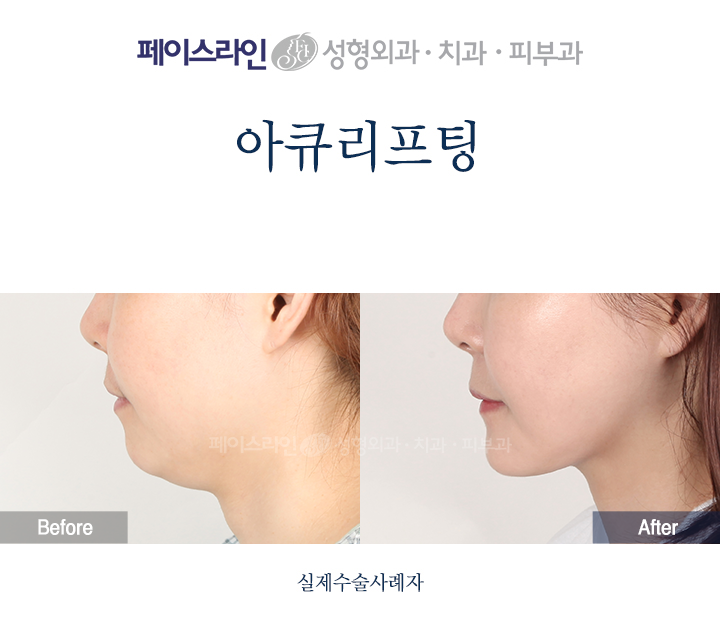Accu lifting: lower-face profile comparison 02 before and after at Faceline Plastic Surgery
