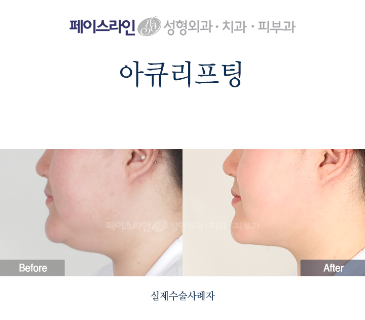 Accu lifting: lower-face profile comparison 03 before and after at Faceline Plastic Surgery
