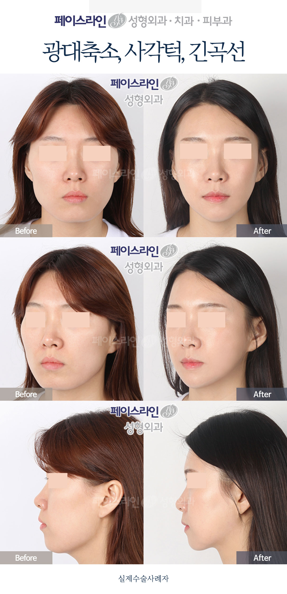 Cheekbone and jaw-angle reduction: comparison 01 before and after at Faceline Plastic Surgery