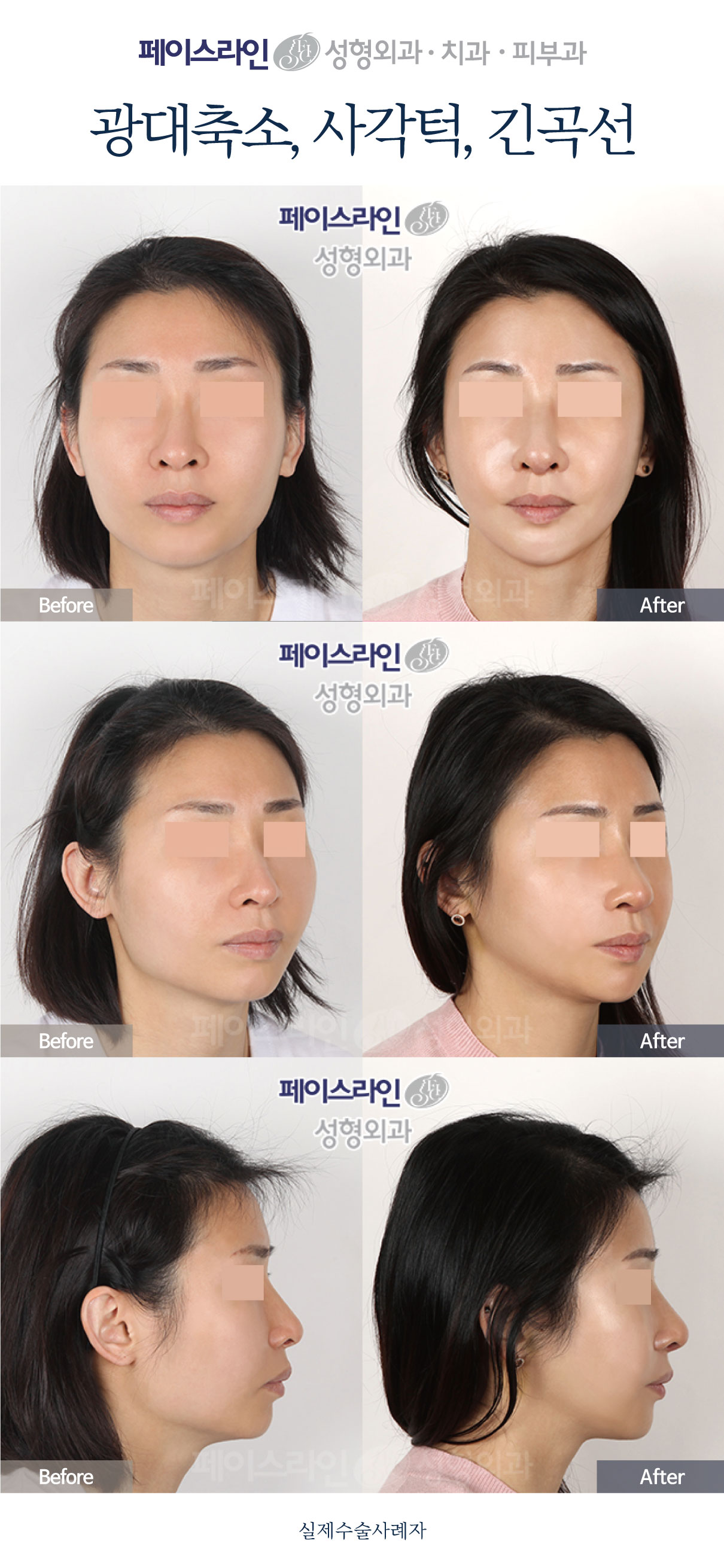 Cheekbone and jaw-angle reduction: comparison 02 before and after at Faceline Plastic Surgery