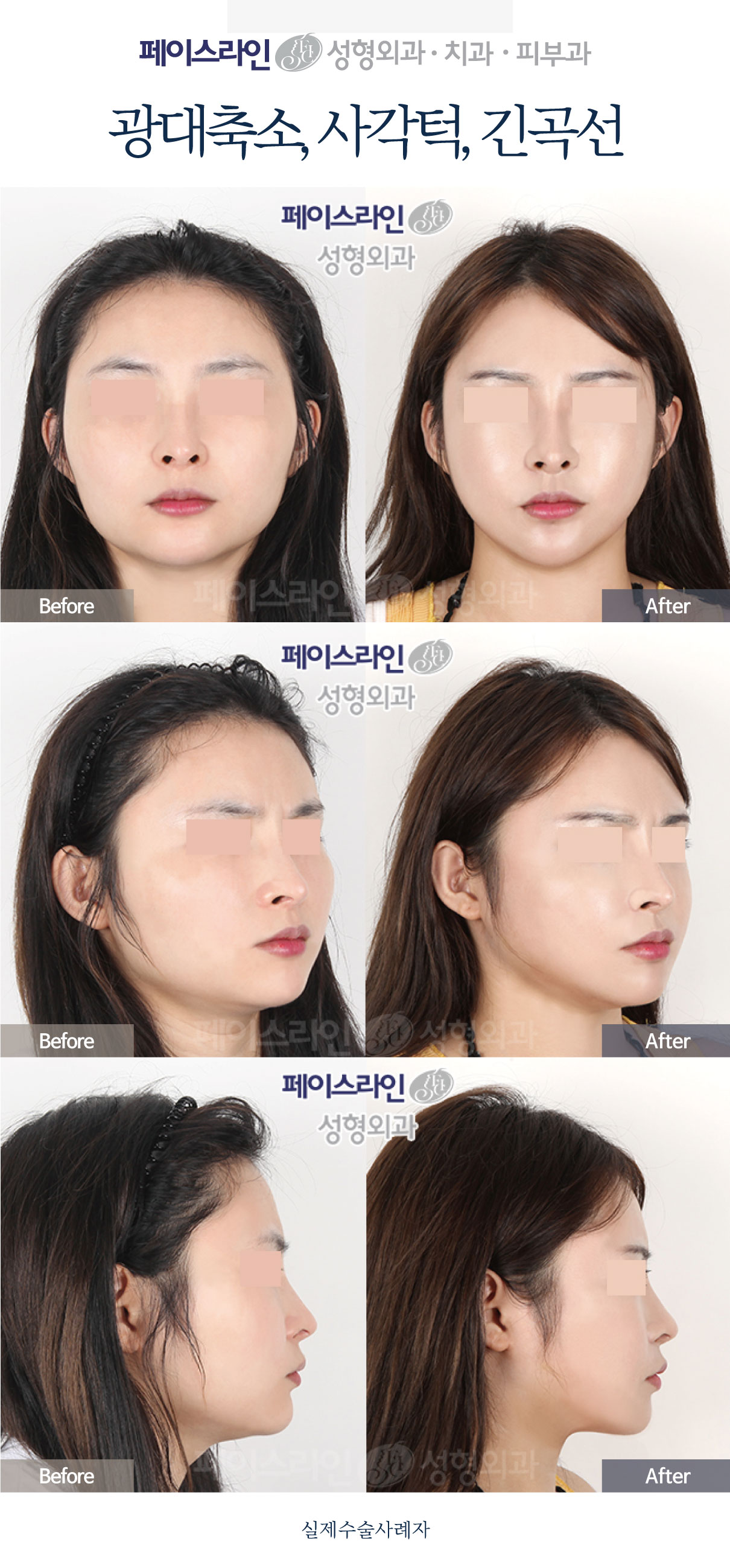 Cheekbone and jaw-angle reduction: comparison 03 before and after at Faceline Plastic Surgery