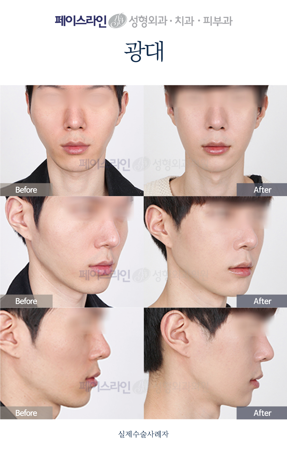 Cheekbone contouring: front, angled and profile comparison before and after at Faceline Plastic Surgery