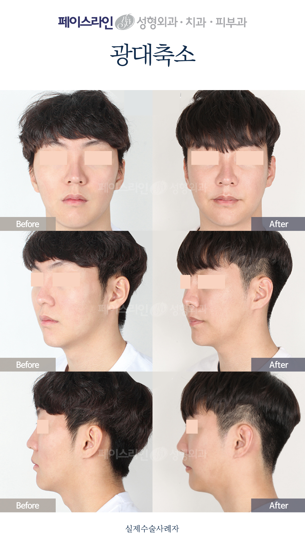 Cheekbone reduction: three-view comparison 01 before and after at Faceline Plastic Surgery