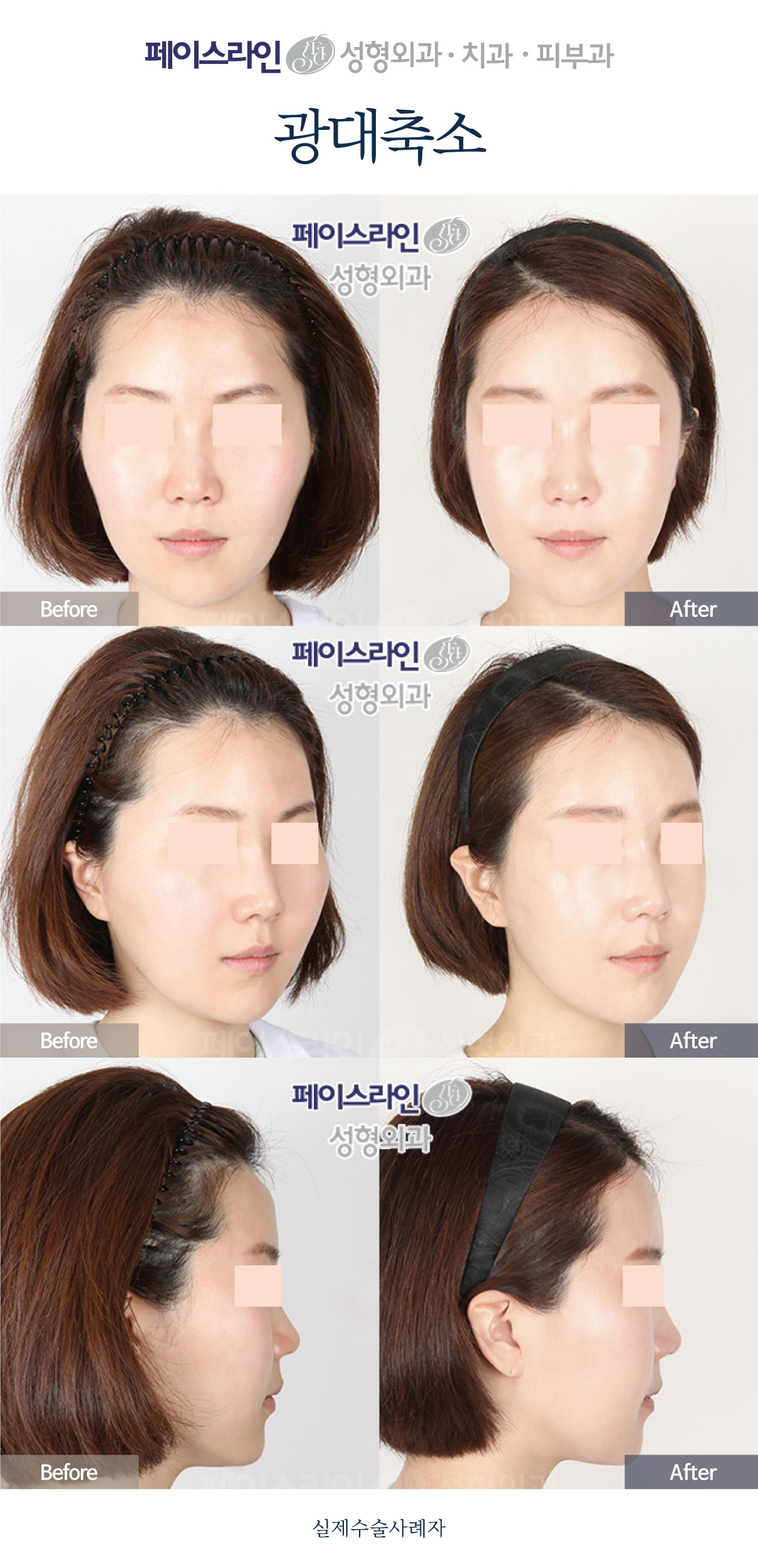Cheekbone reduction: three-view comparison 02 before and after at Faceline Plastic Surgery