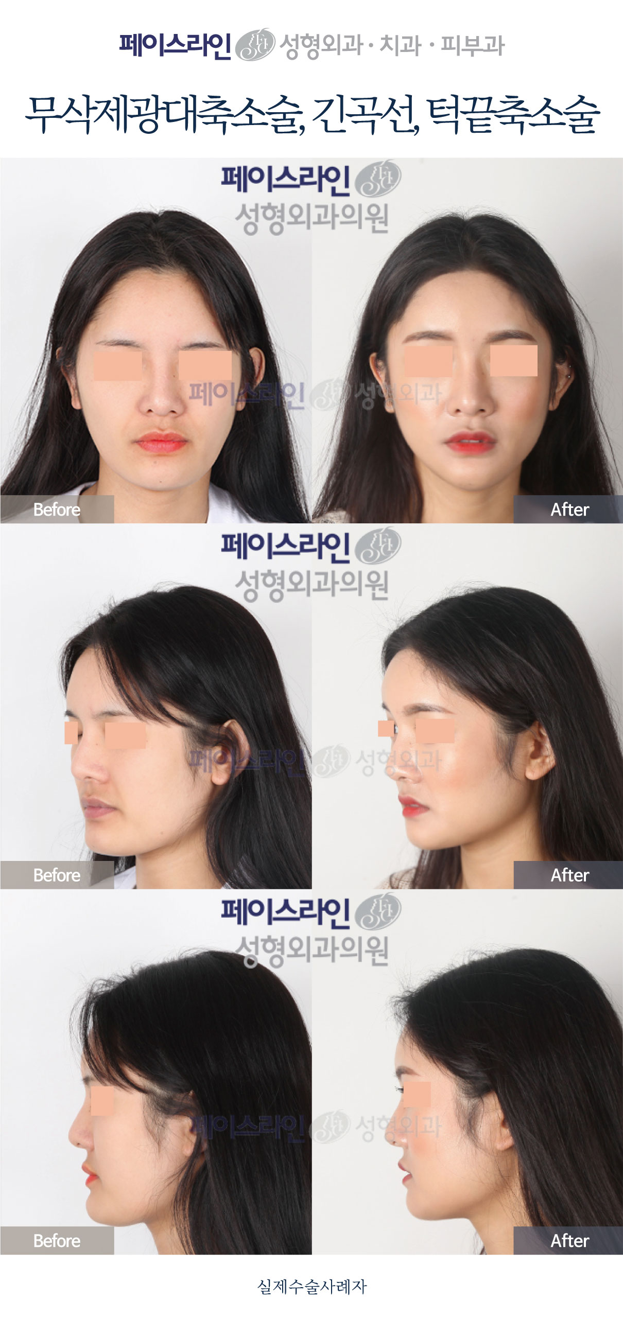 Cheekbone reduction with long-curve jaw and chin reduction before and after at Faceline Plastic Surgery