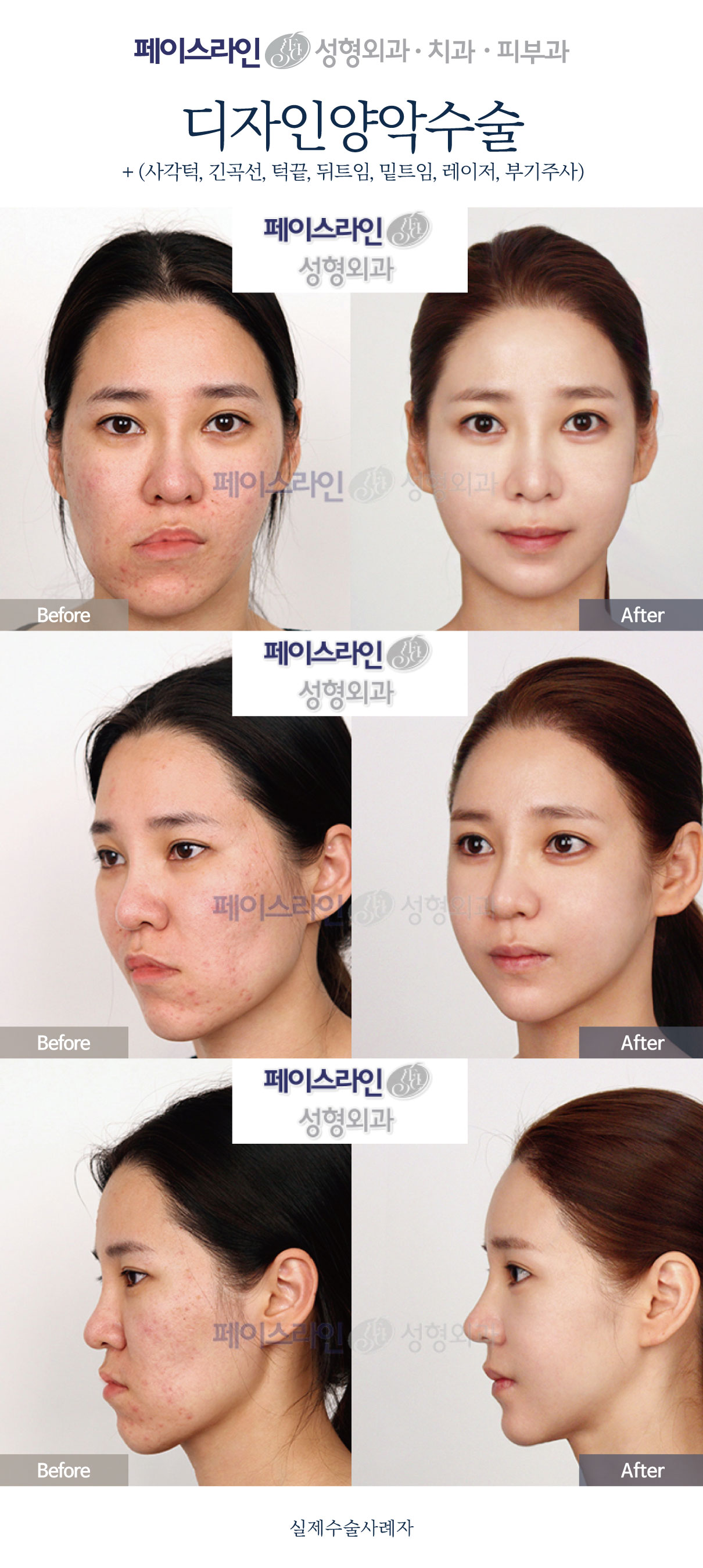Design double jaw surgery with eyelid and jaw contouring before and after at Faceline Plastic Surgery