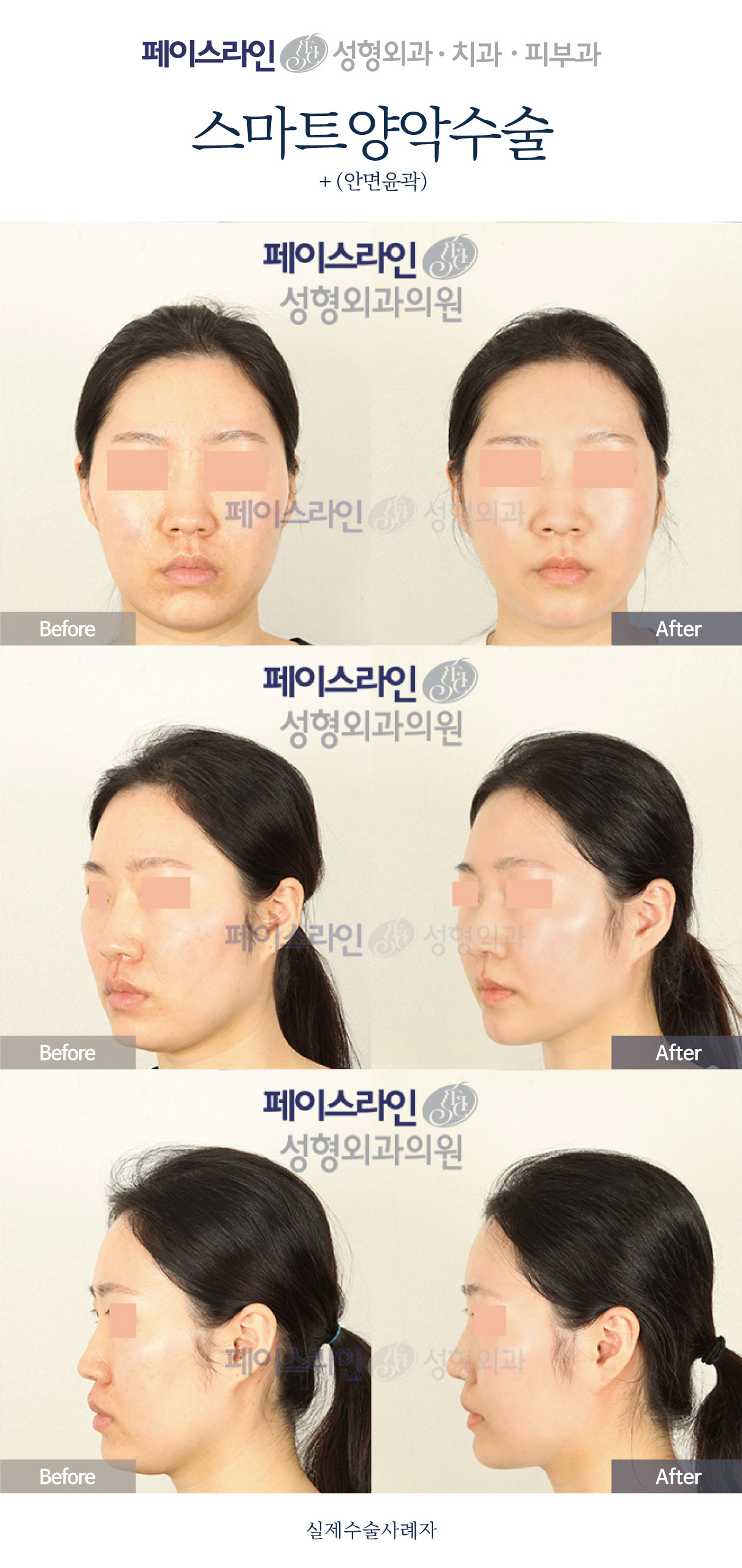 Double jaw surgery and facial contouring: comparison 01 before and after at Faceline Plastic Surgery