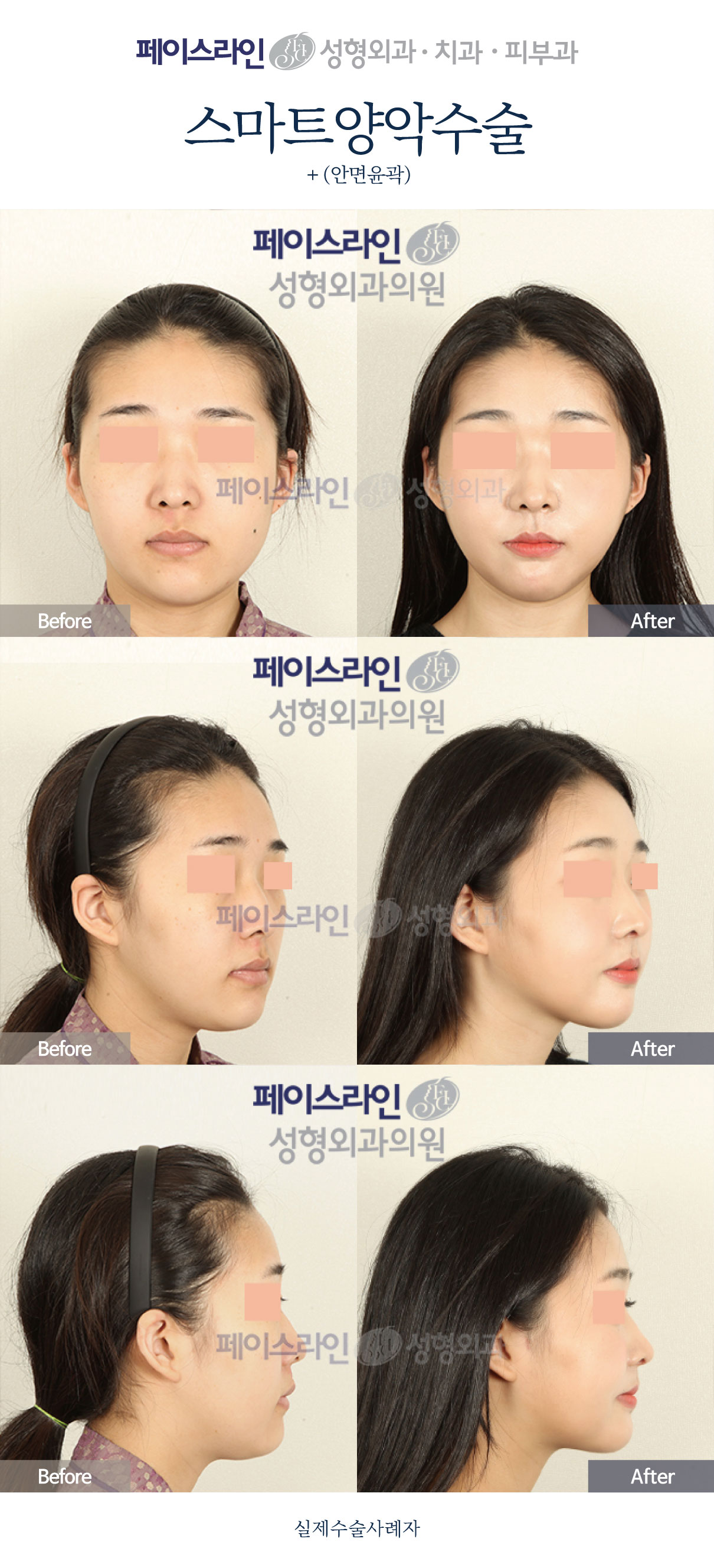 Double jaw surgery and facial contouring: comparison 02 before and after at Faceline Plastic Surgery