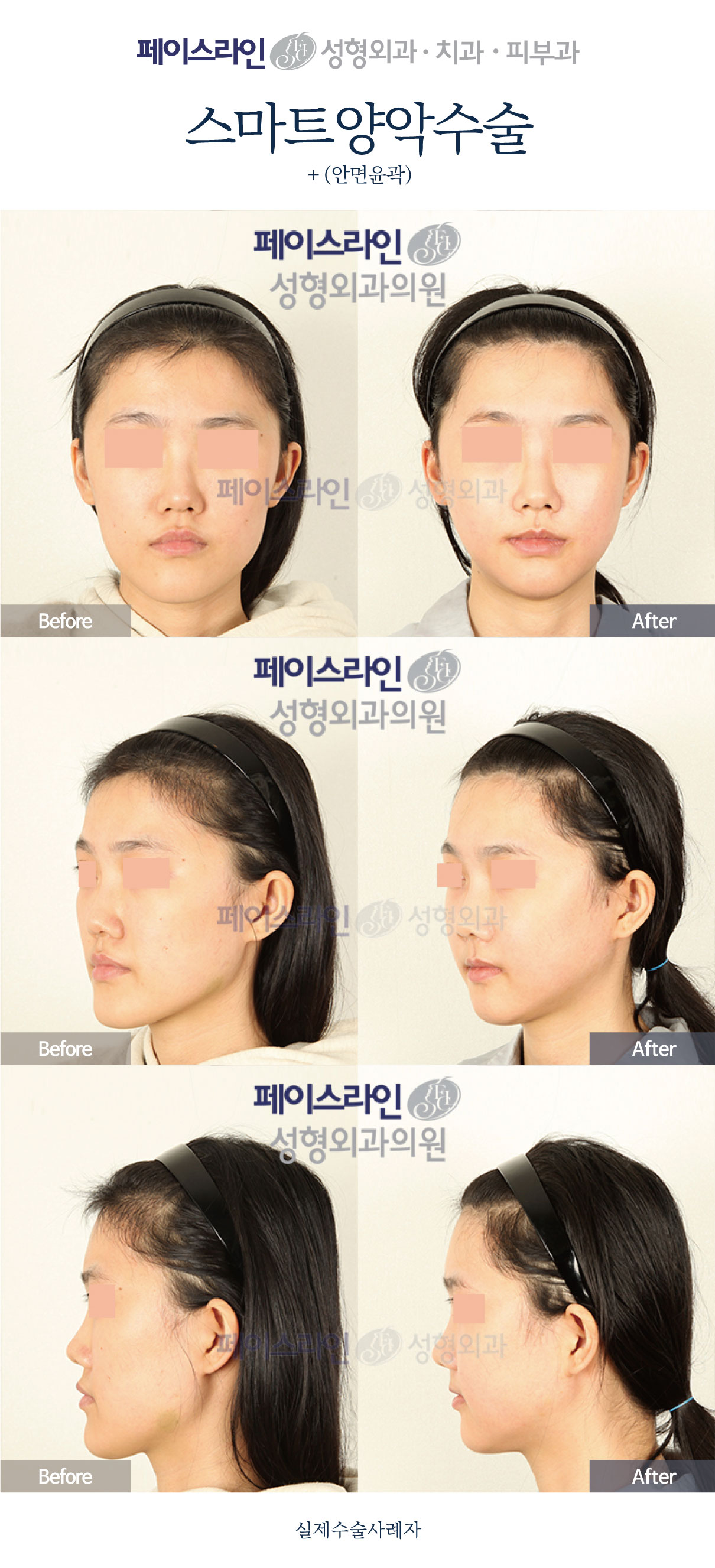 Double jaw surgery and facial contouring: comparison 03 before and after at Faceline Plastic Surgery