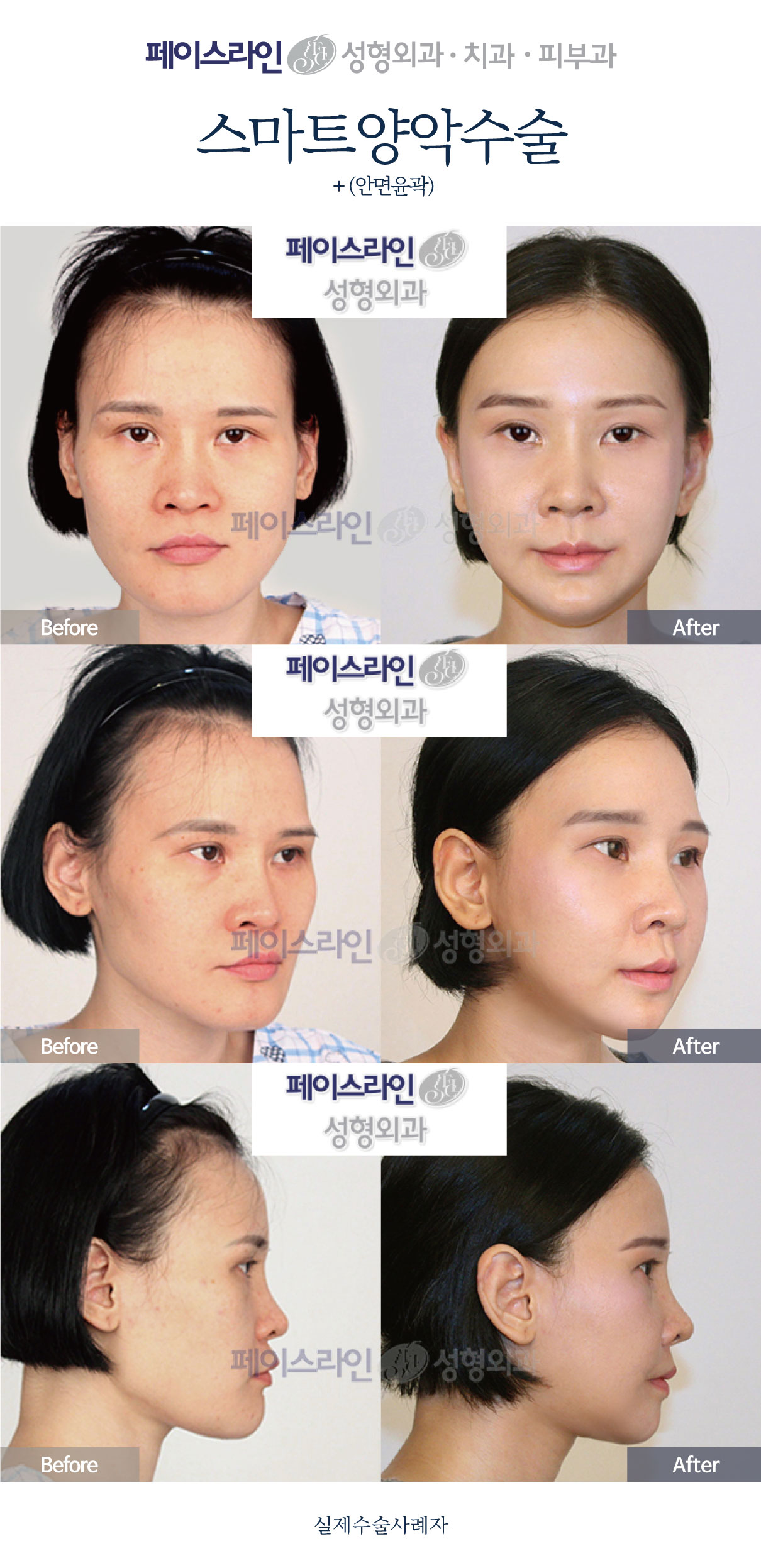 Double jaw surgery and facial contouring: comparison 04 before and after at Faceline Plastic Surgery
