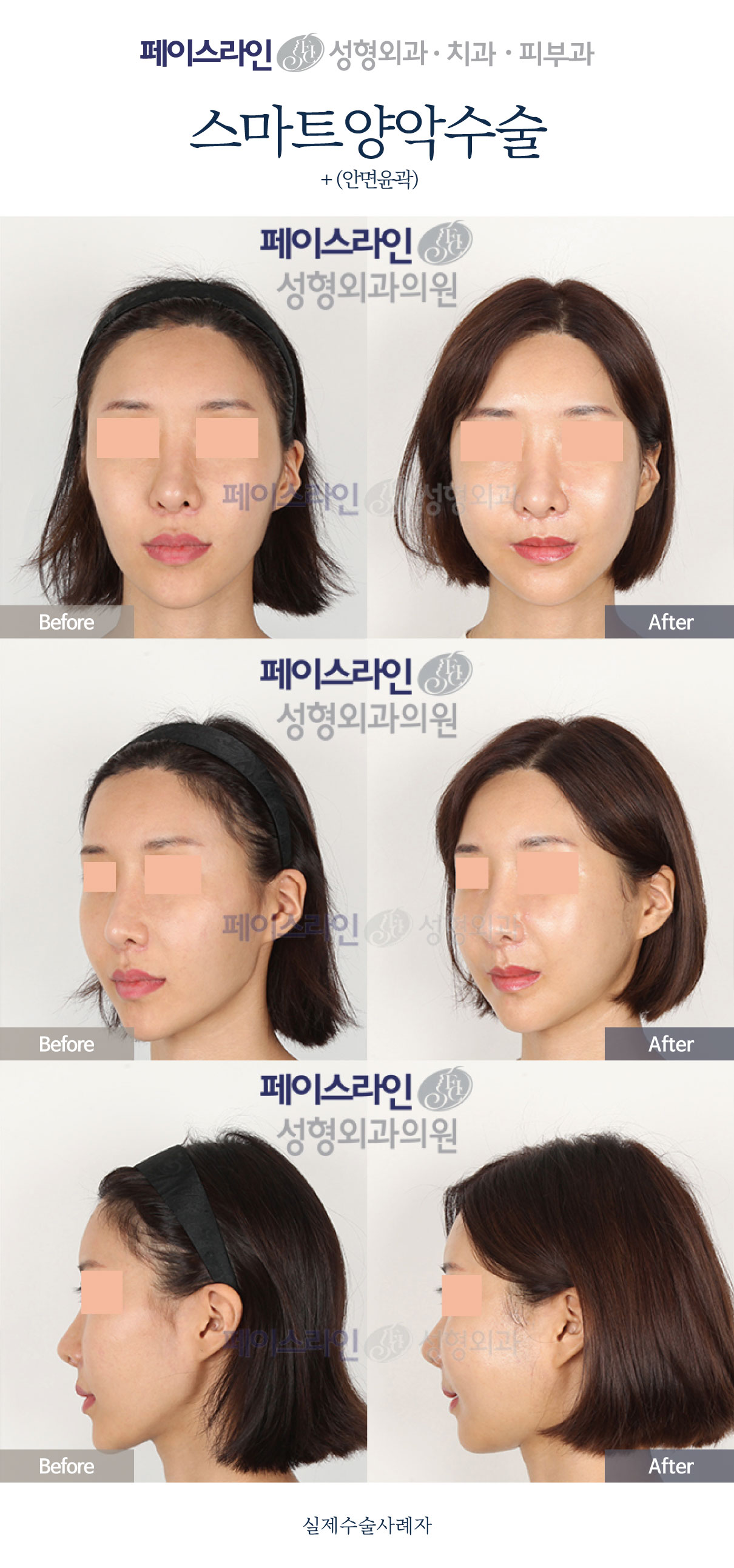 Double jaw surgery and facial contouring: comparison 05 before and after at Faceline Plastic Surgery