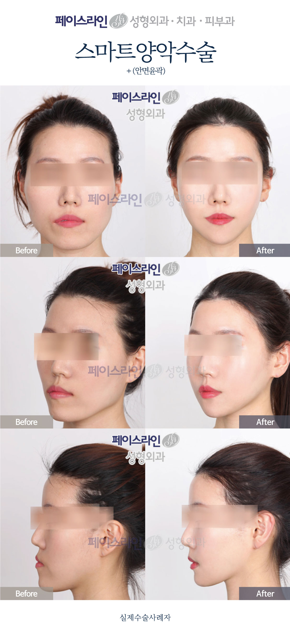 Double jaw surgery and facial contouring: comparison 06 before and after at Faceline Plastic Surgery