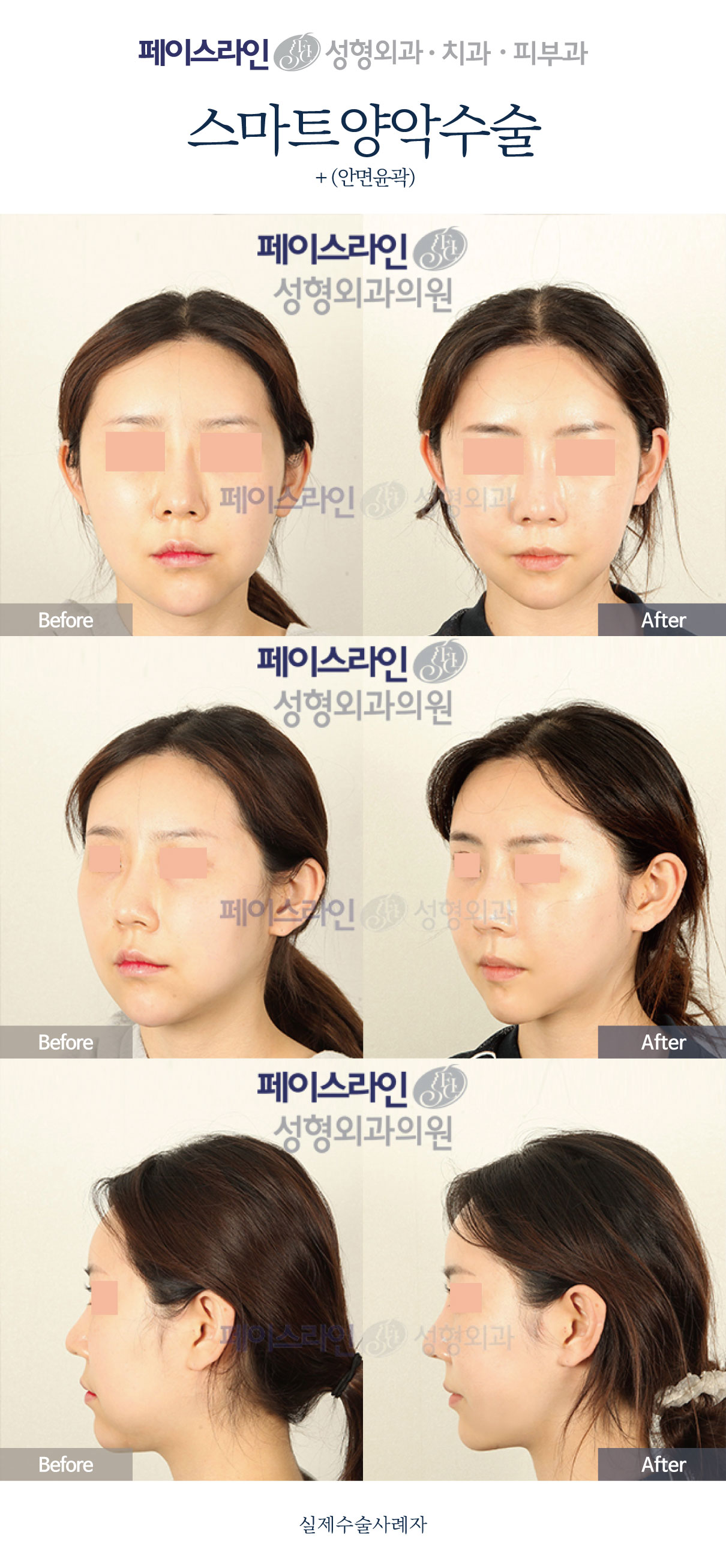 Double jaw surgery and facial contouring: comparison 07 before and after at Faceline Plastic Surgery