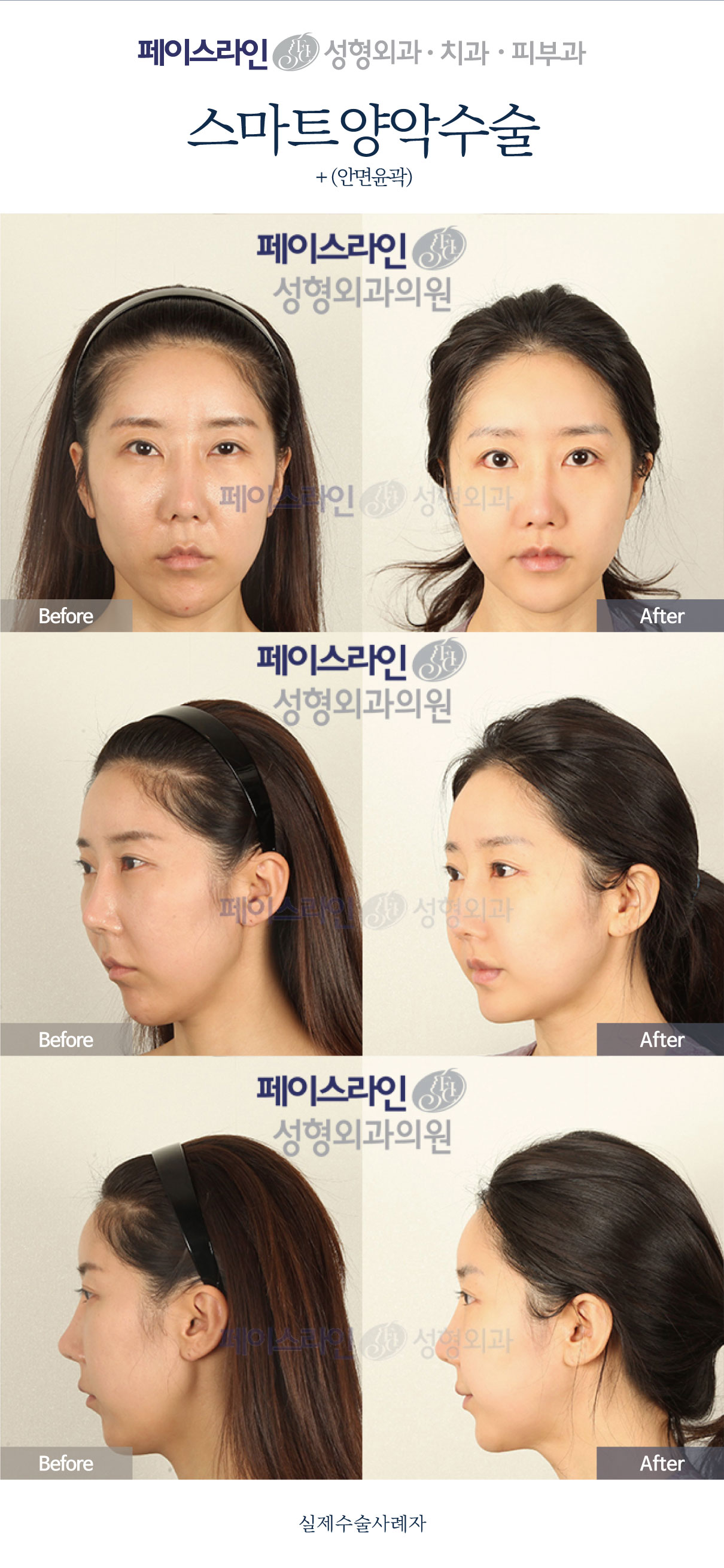 Double jaw surgery and facial contouring: comparison 08 before and after at Faceline Plastic Surgery