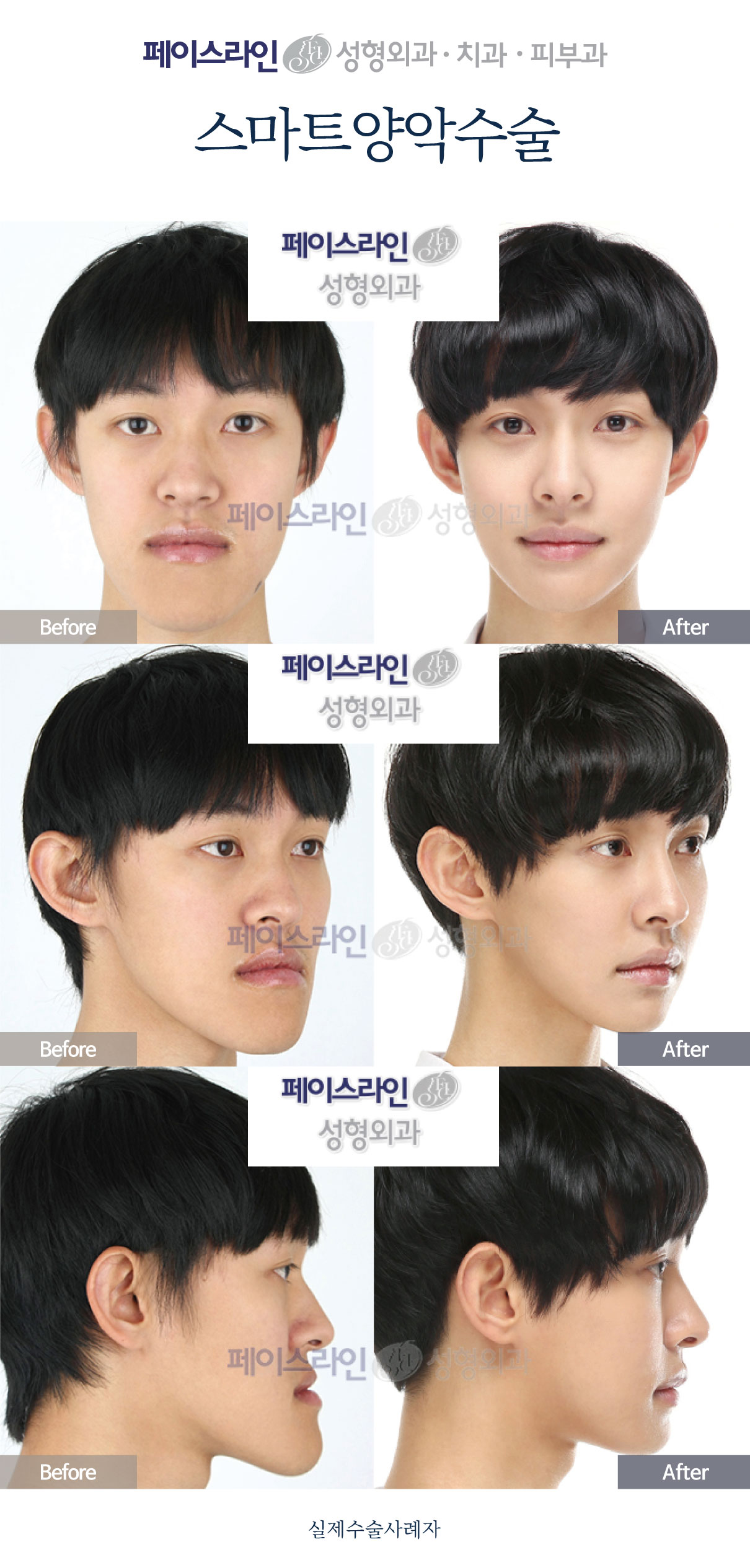 Double jaw surgery: three-view comparison before and after at Faceline Plastic Surgery