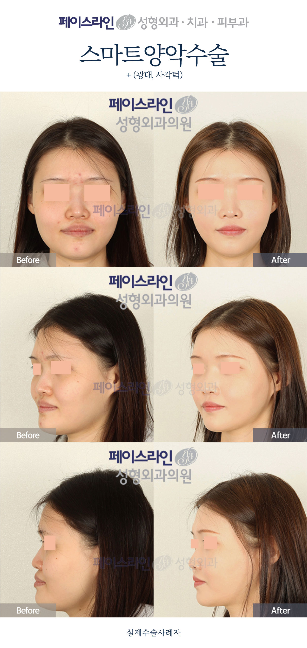 Double jaw surgery with cheekbone and jaw-angle contouring before and after at Faceline Plastic Surgery