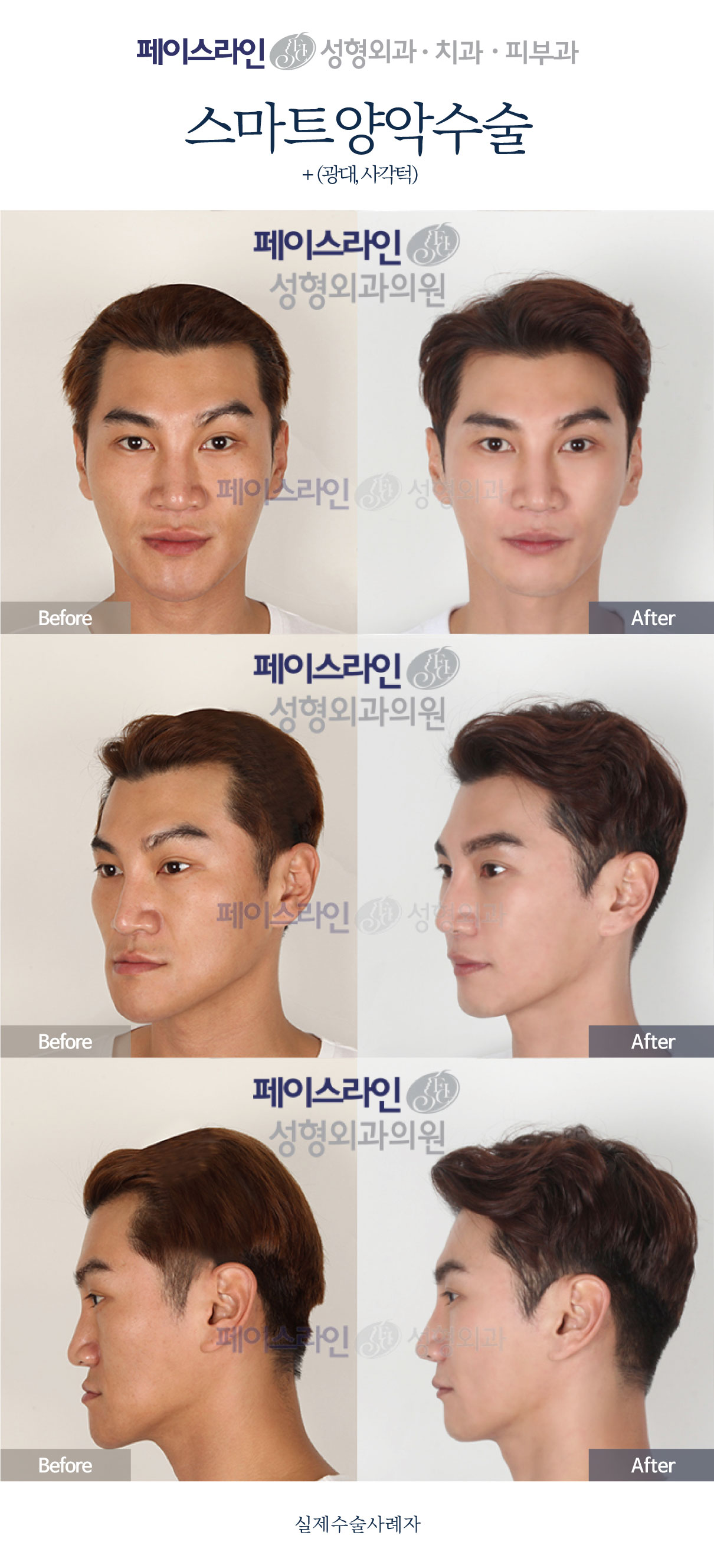 Double jaw surgery with cheekbone and jaw-angle procedures before and after at Faceline Plastic Surgery